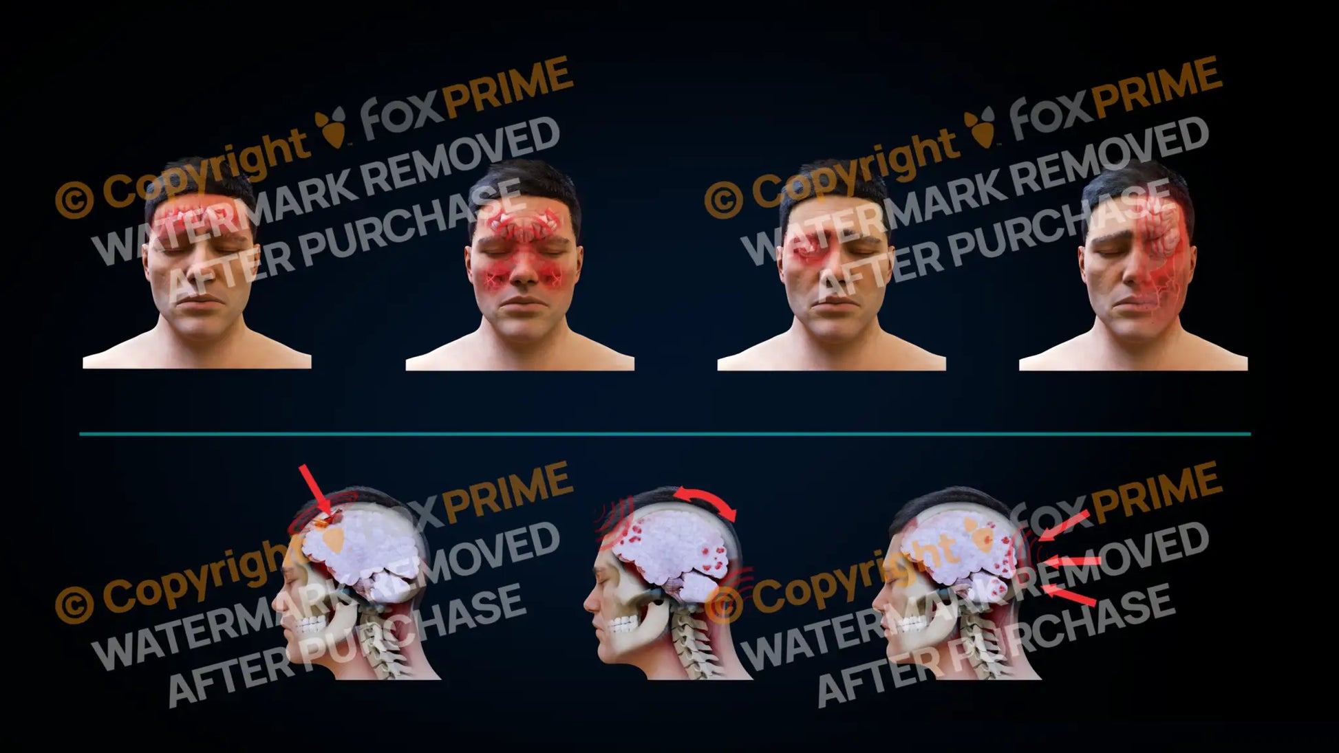 Headache Types (No Text) Still Shot