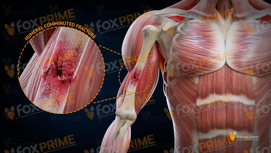 Humeral Comminuted Fracture Right Still Shot