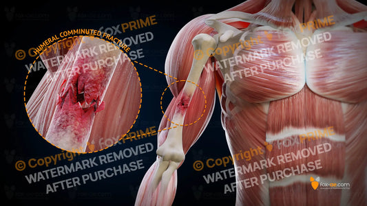 Humeral Comminuted Fracture Right Still Shot