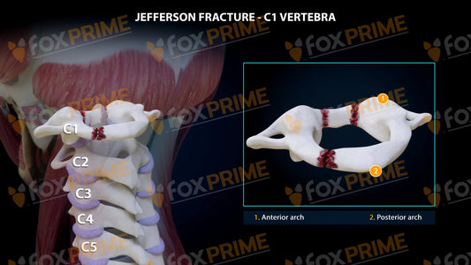 Jefferson Fracture 3 Fragments Still Shot