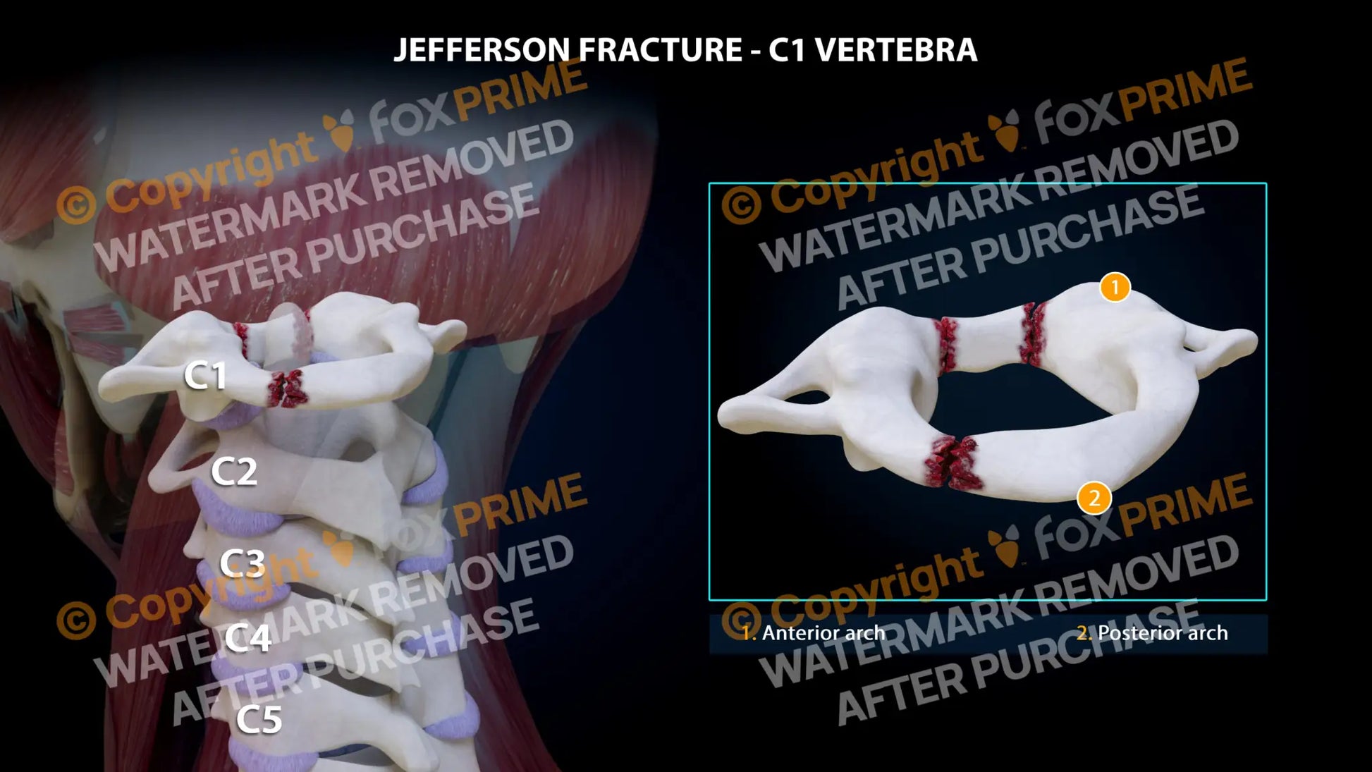 Jefferson Fracture 3 Fragments Still Shot