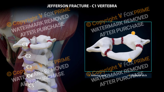 Jefferson Fracture 4 Fragments Still Shot