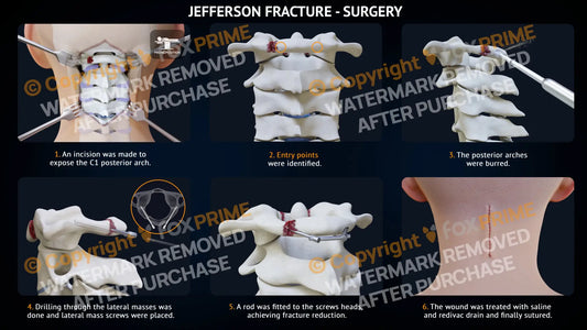 Jefferson Fracture Surgery Single Use / Light Still Shot