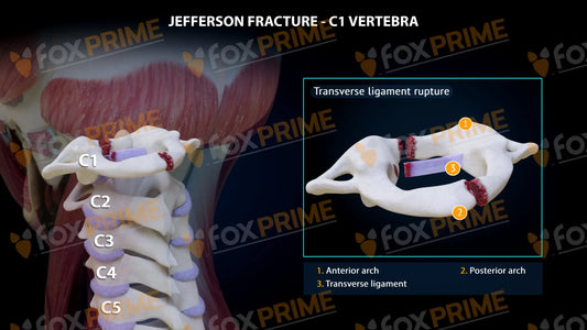 Jefferson Fracture Transverse Ligament Rupture Type I Still Shot