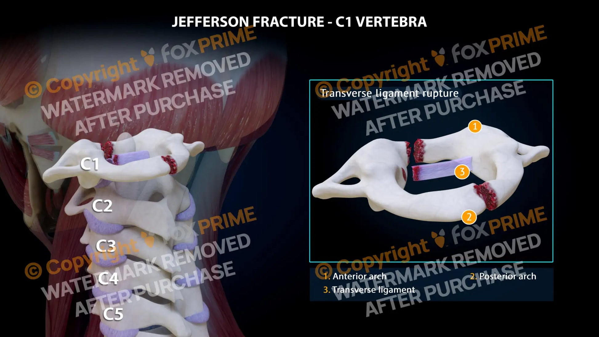 Jefferson Fracture Transverse Ligament Rupture Type I Still Shot