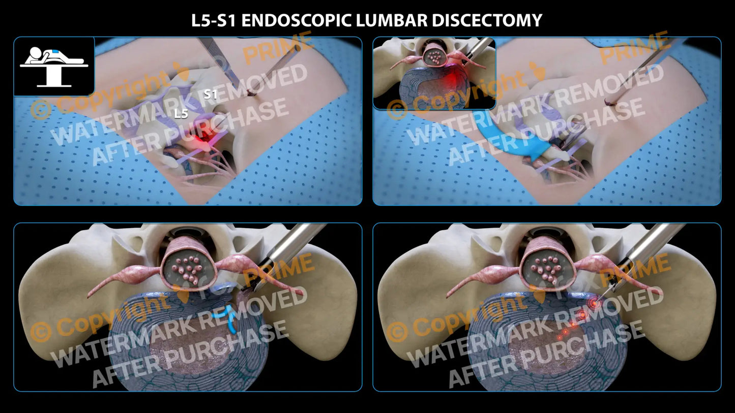 L5-S1 Endoscopic Lumbar Discectomy (No Text) Still Shot