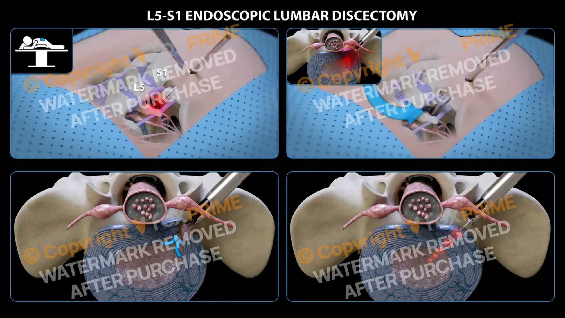 L5-S1 Endoscopic Lumbar Discectomy (No Text) Still Shot