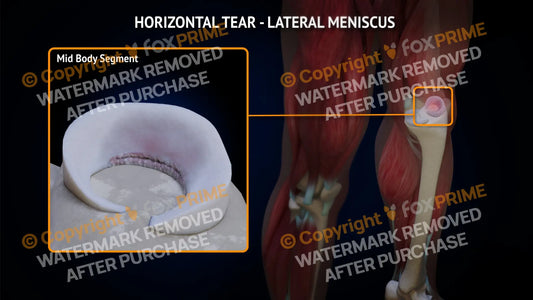 Lateral Meniscus Tear - Horizontal Left Leg Type 1 Still Shot