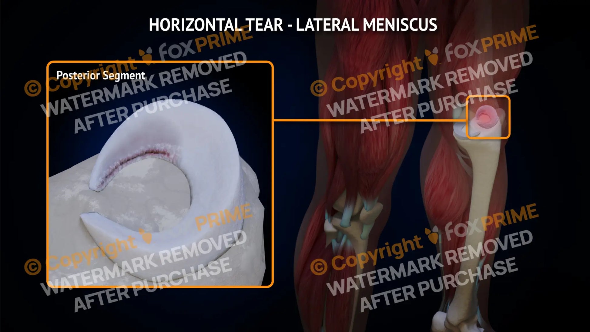 Lateral Meniscus Tear - Horizontal Left Leg Type 2 Still Shot