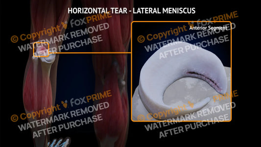 Lateral Meniscus Tear - Horizontal Left Leg Type 3 Still Shot