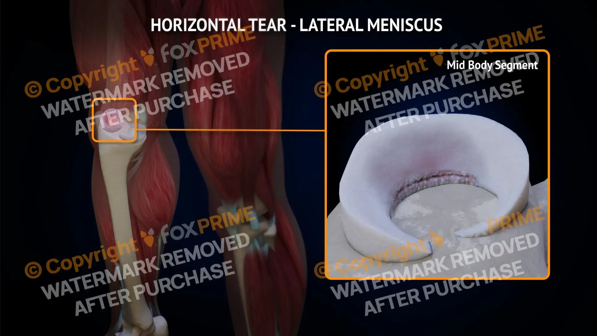 Lateral Meniscus Tear - Horizontal Right Leg Type 1 Still Shot