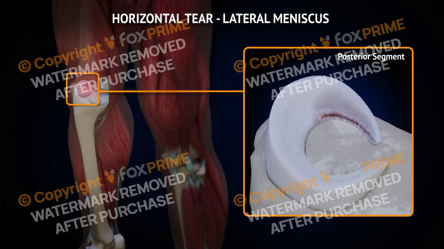 Lateral Meniscus Tear - Horizontal Right Leg Type 2 Still Shot
