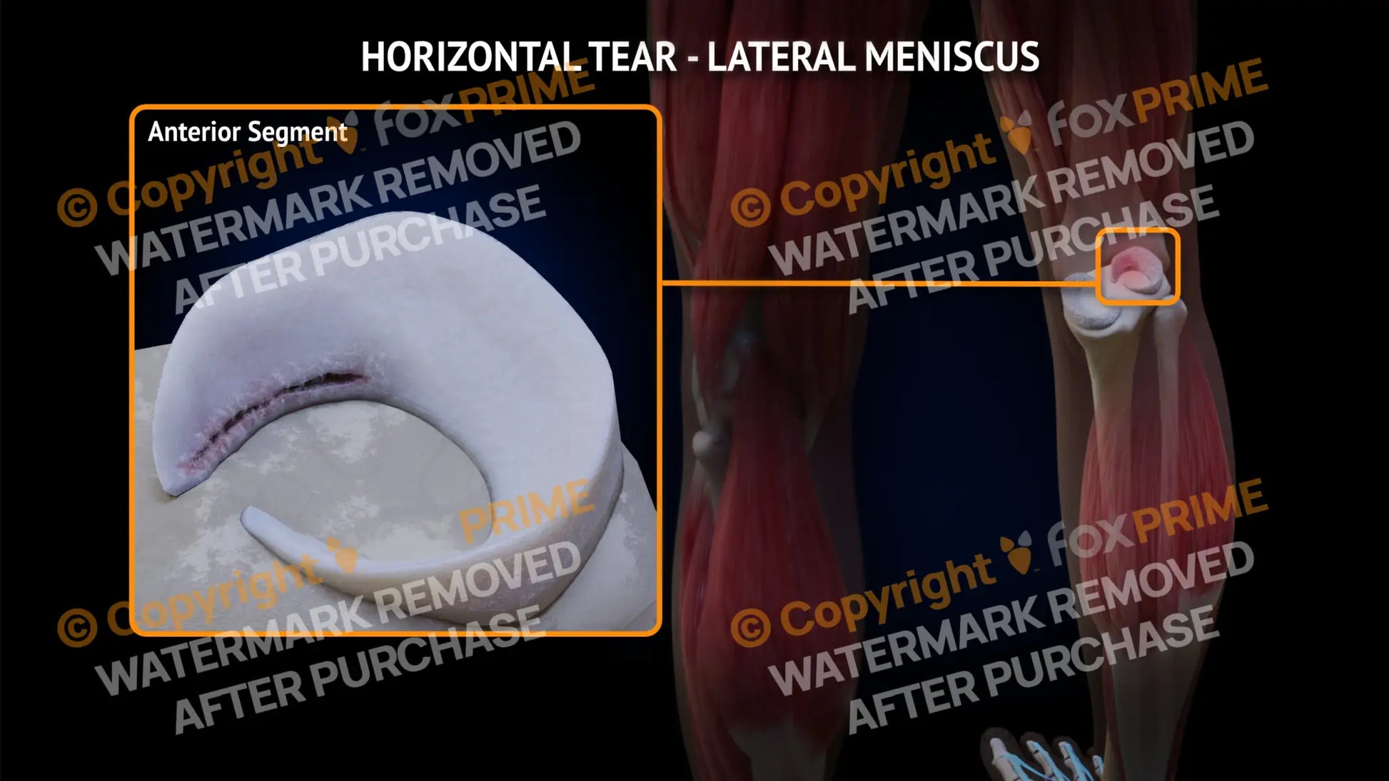 Lateral Meniscus Tear - Horizontal Right Leg Type 3 Still Shot
