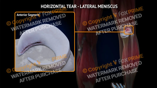 Lateral Meniscus Tear - Horizontal Right Leg Type 3 Still Shot