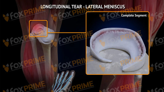 Lateral Meniscus Tear - Longitudinal Left Leg Type 1 Still Shot