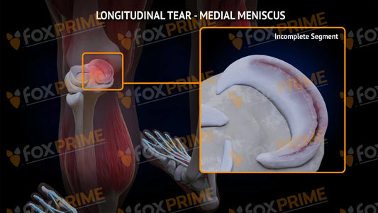 Lateral Meniscus Tear - Longitudinal Left Leg Type 2 Still Shot