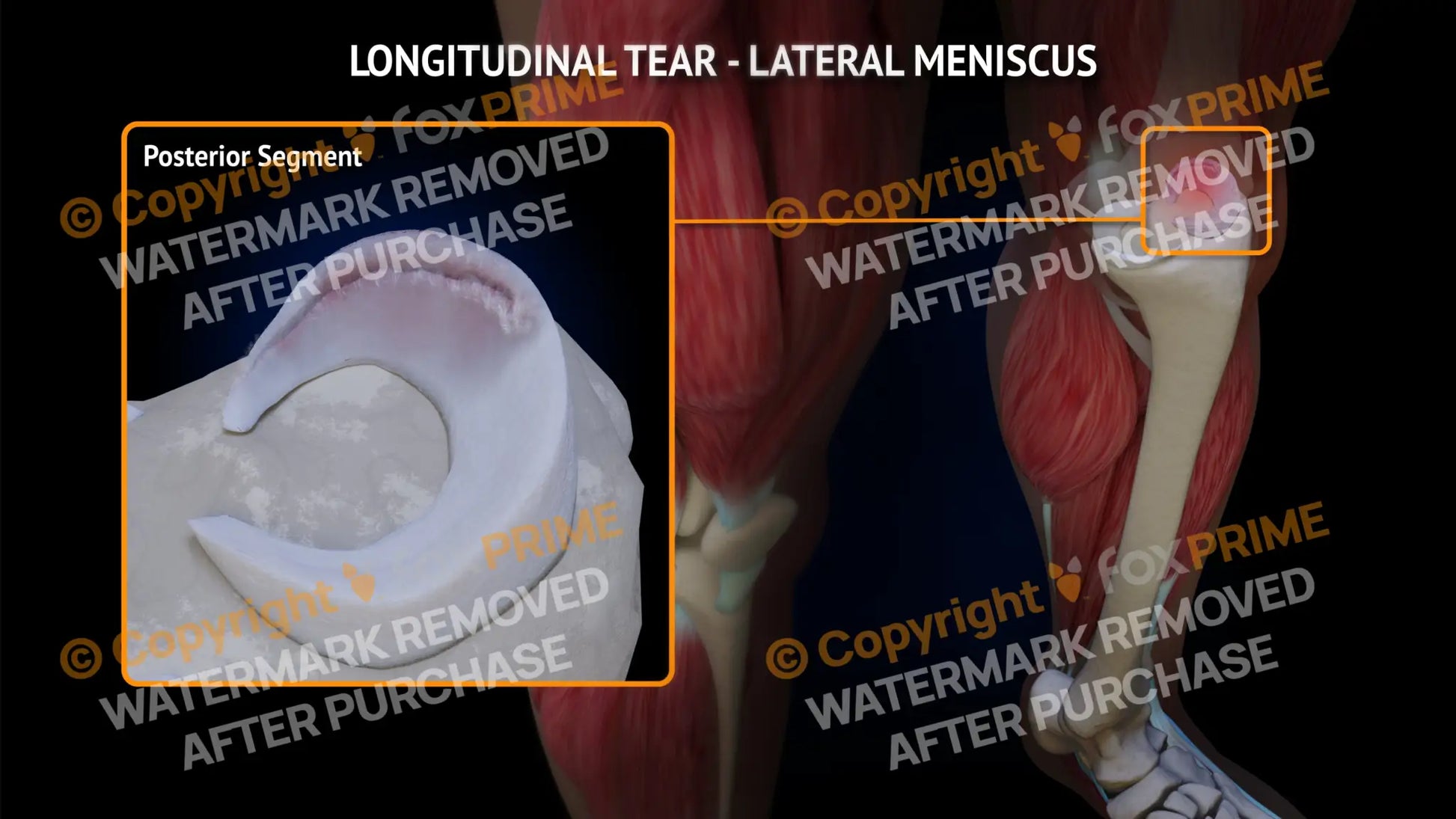 Lateral Meniscus Tear - Longitudinal Left Leg Type 3 Still Shot