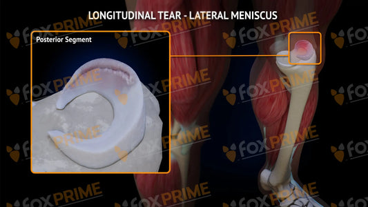 Lateral Meniscus Tear - Longitudinal Left Leg Type 3 Still Shot