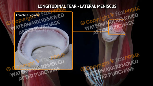 Lateral Meniscus Tear - Longitudinal Right Leg Type 1 Still Shot