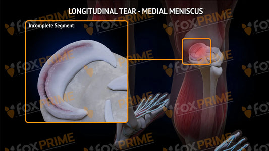 Lateral Meniscus Tear - Longitudinal Right Leg Type 2 Still Shot