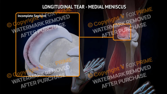 Lateral Meniscus Tear - Longitudinal Right Leg Type 2 Still Shot