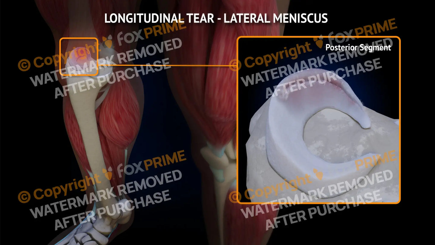 Lateral Meniscus Tear - Longitudinal Right Leg Type 3 Still Shot