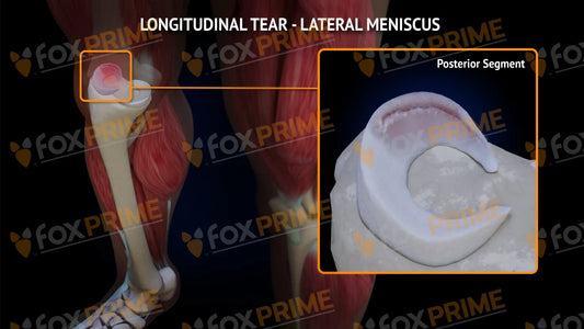 Lateral Meniscus Tear - Longitudinal Right Leg Type 3 Still Shot