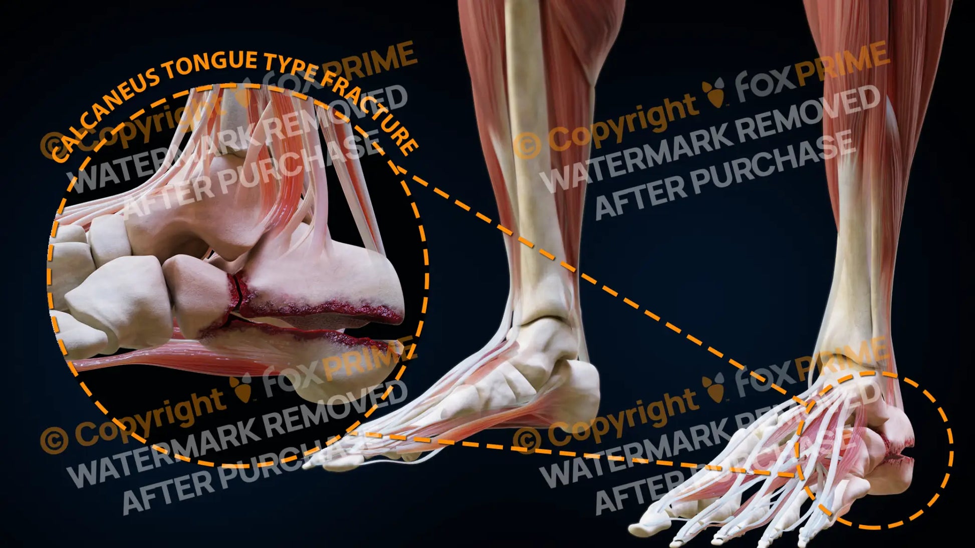 Left Calcaneus Tongue Type Fracture Still Shot