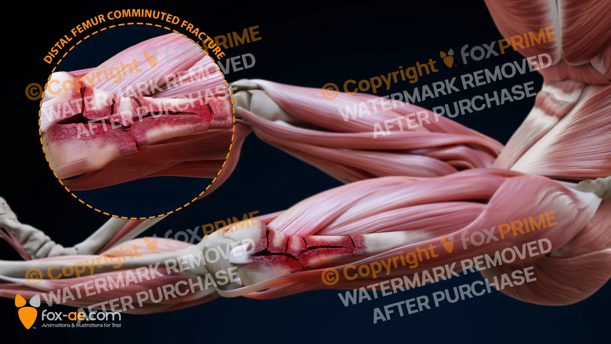 Left Distal Femur Comminuted Fracture Still Shot