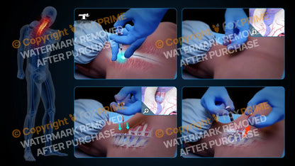 Left Epidural Injection C7-T1 (No Text) Still Shot