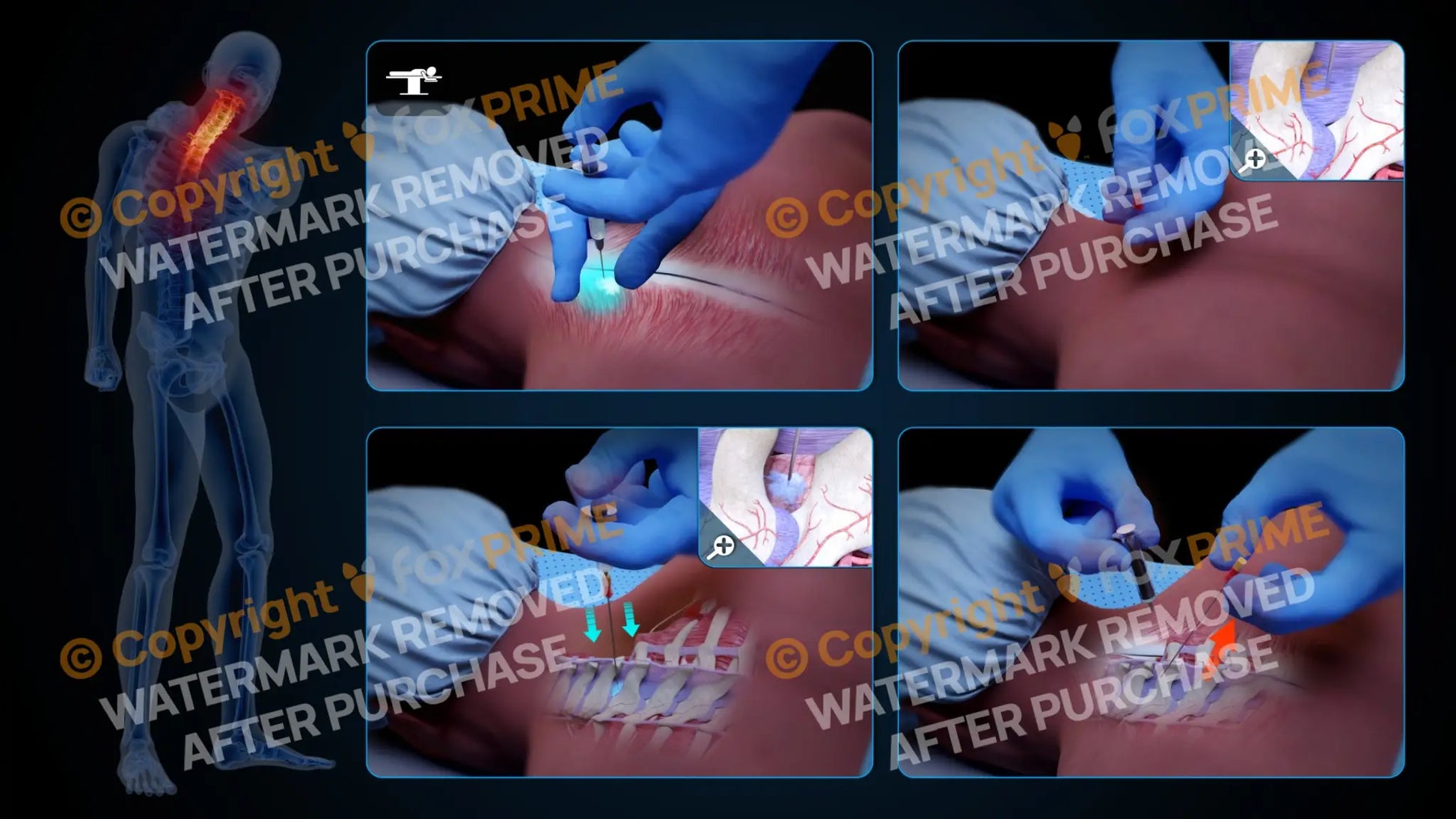 Left Epidural Injection C7-T1 (No Text) Still Shot