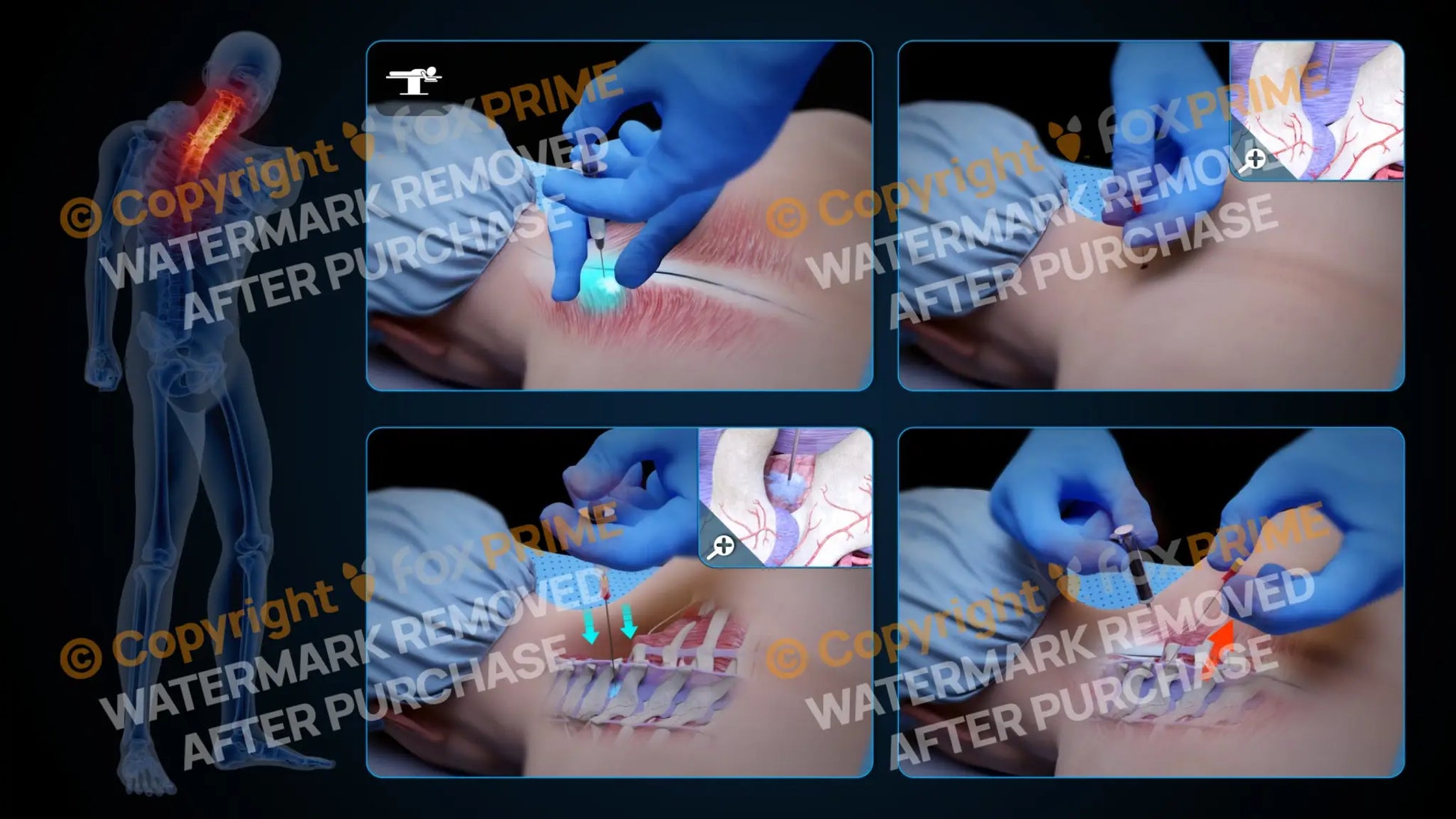 Left Epidural Injection C7-T1 (No Text) Still Shot