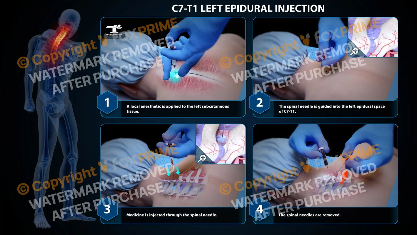 Left Epidural Injection C7-T1 (PowerPoint) PowerPoint