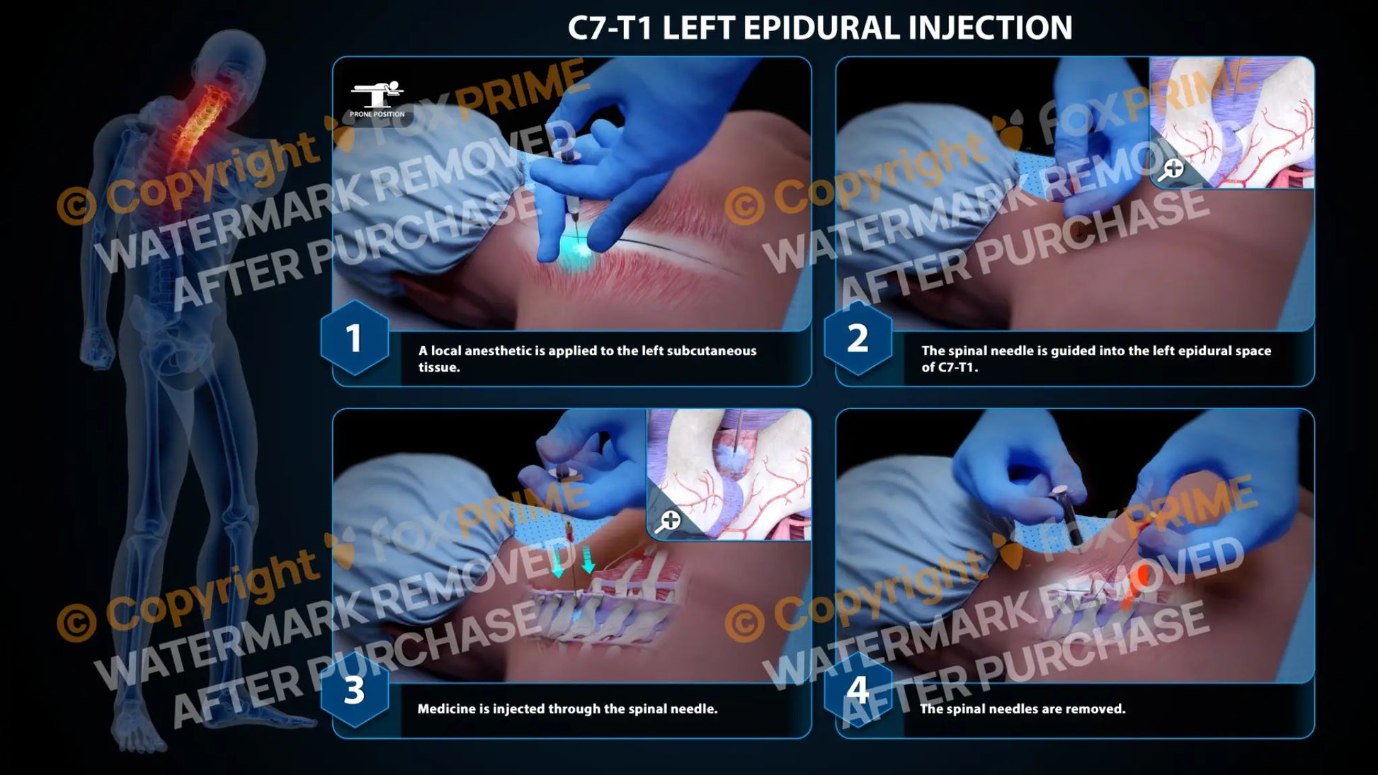 Left Epidural Injection C7-T1 (PowerPoint) PowerPoint