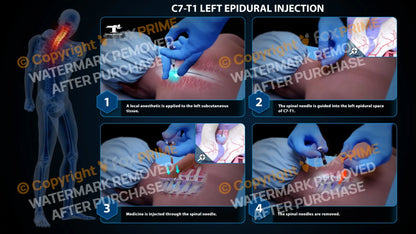 Left Epidural Injection C7-T1 (PowerPoint) PowerPoint