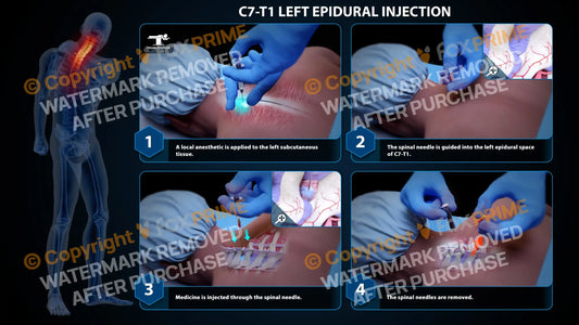 Left Epidural Injection C7-T1 Still Shot