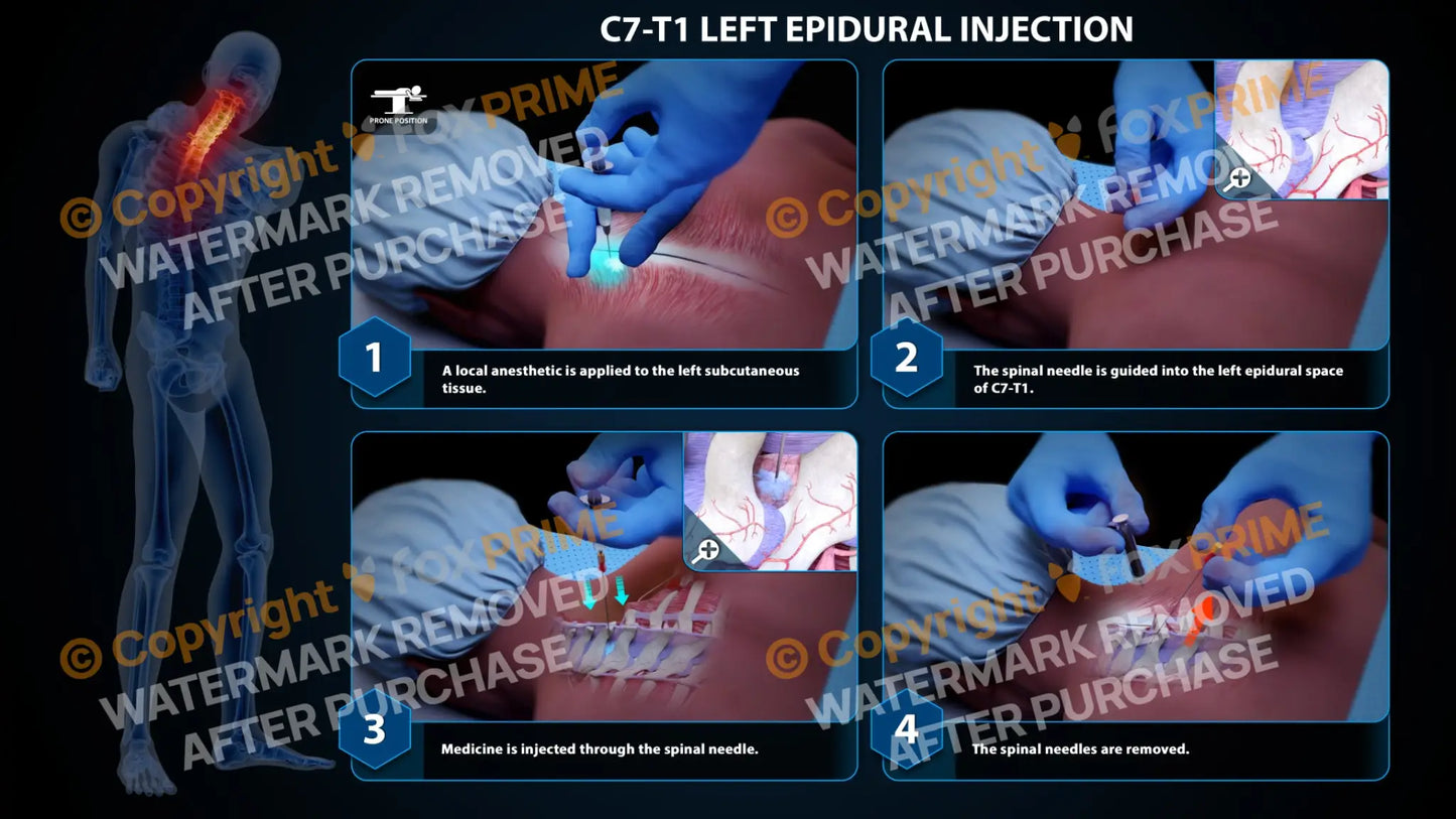 Left Epidural Injection C7-T1 Still Shot