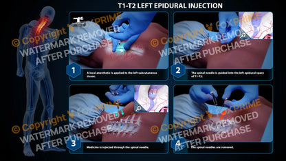 Left Epidural Injection T1-T2 (PowerPoint) PowerPoint