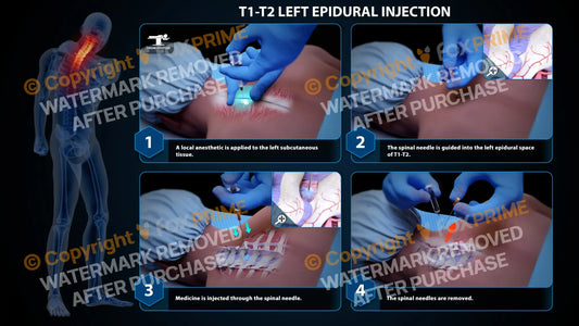 Left Epidural Injection T1-T2 Still Shot