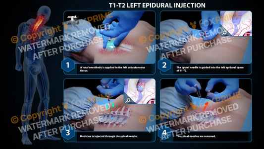 Left Epidural Injection T1-T2 Still Shot