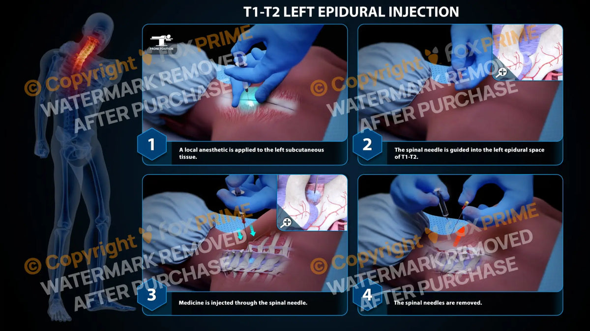 Left Bottom Injection Left Epidural Injection T1-T2 – FoxPrime