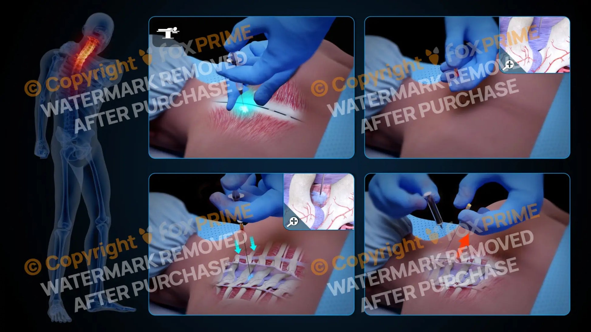 Left Epidural Injection T2-T3 (No Text) Still Shot