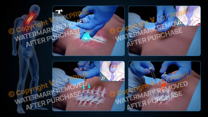 Left Epidural Injection T2-T3 (No Text) Still Shot