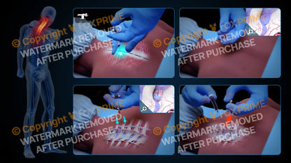 Left Epidural Injection T2-T3 (No Text) Still Shot