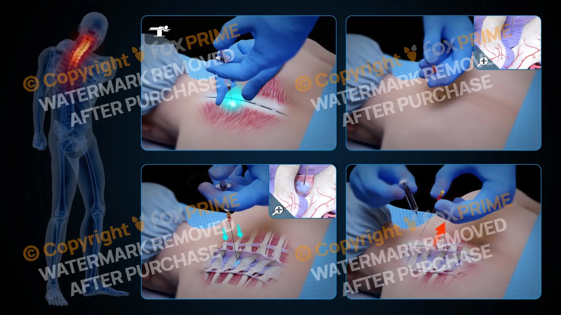 Left Epidural Injection T2-T3 (No Text) Still Shot