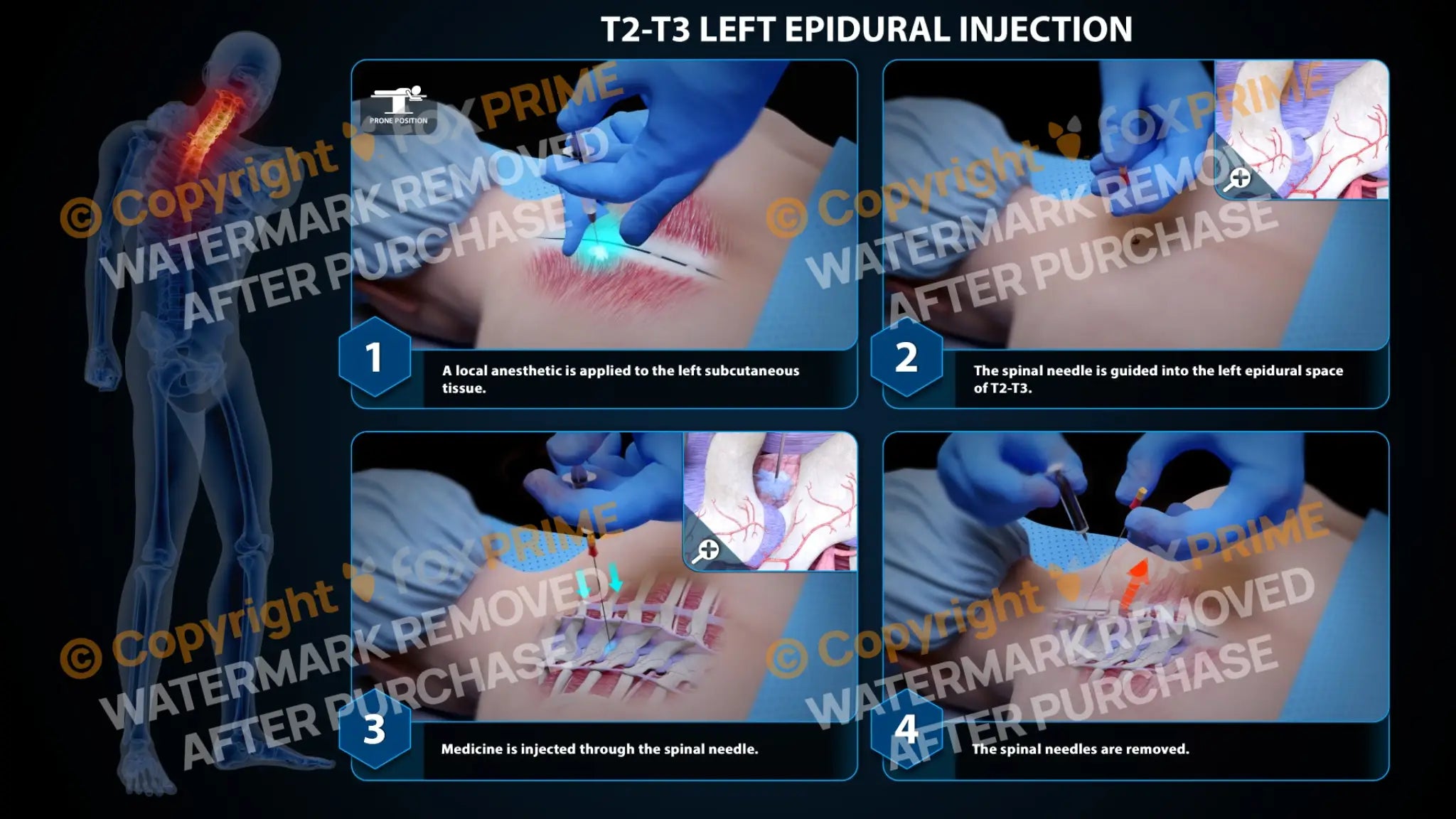Left Bottom Injection Left Epidural Injection T2-T3 (PowerPoint) – FoxPrime