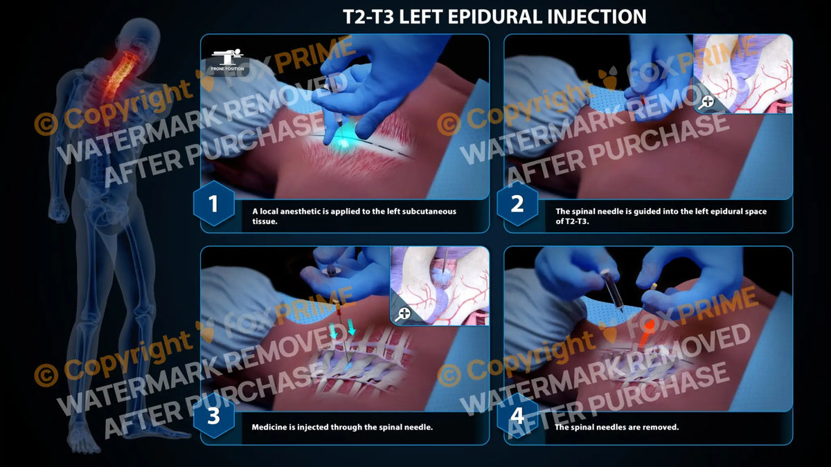 Left Bottom Injection Left Epidural Injection T2-T3 (PowerPoint) – FoxPrime