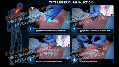 Left Epidural Injection T2-T3 Still Shot