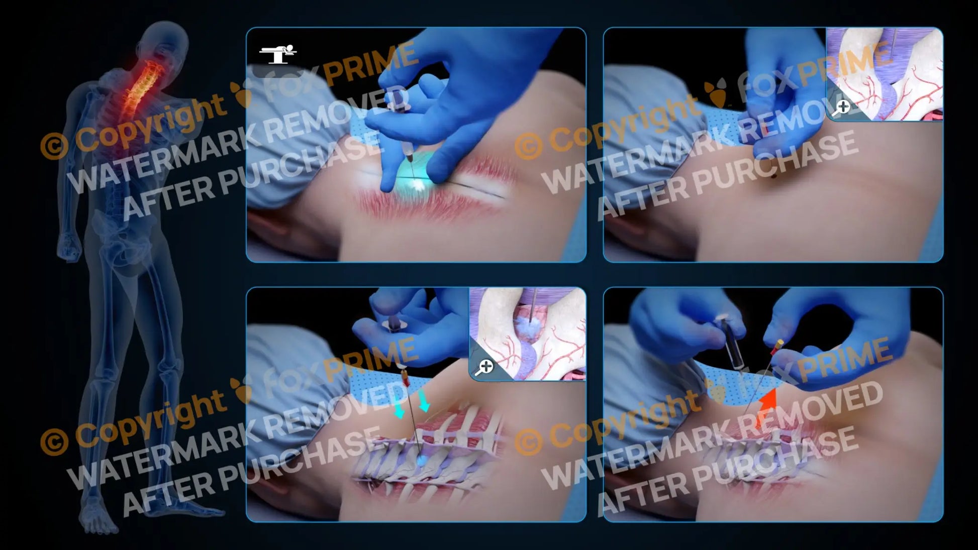Left Epidural Injection T3-T4 (No Text) Still Shot