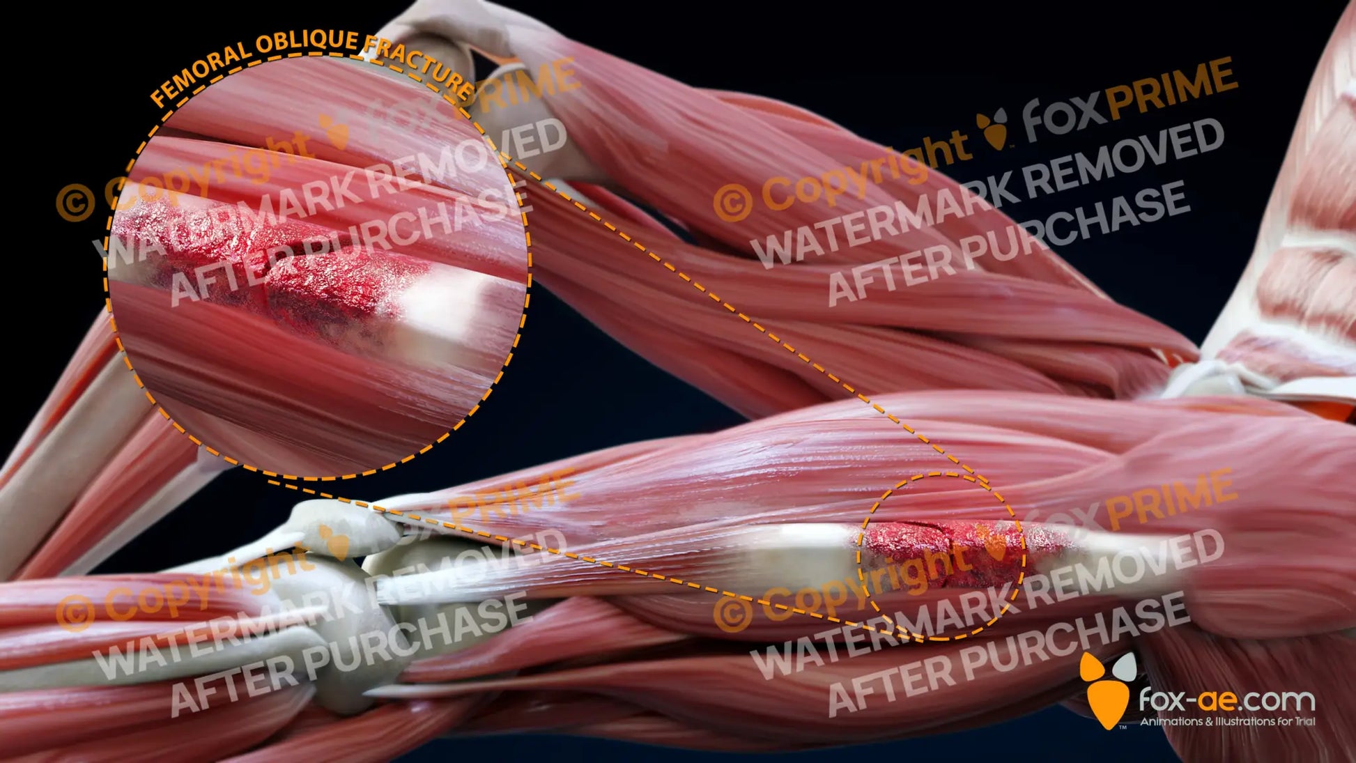 Left Femoral Oblique Fracture Still Shot